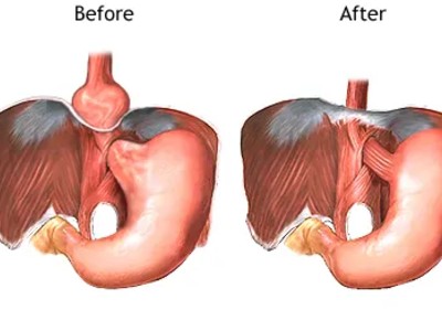 HERNIA